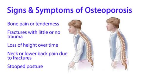 Osteoporosis Causes And Symptoms Funbuzztime