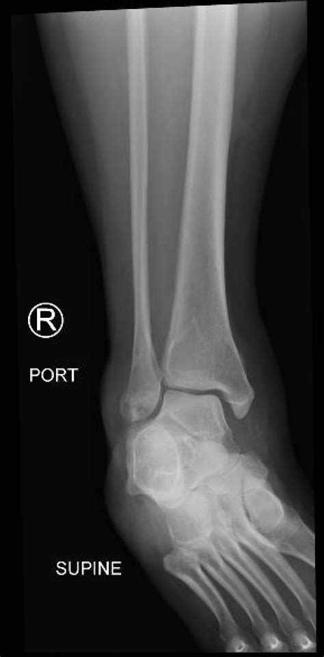 Trimalleolar Fracture - JETem