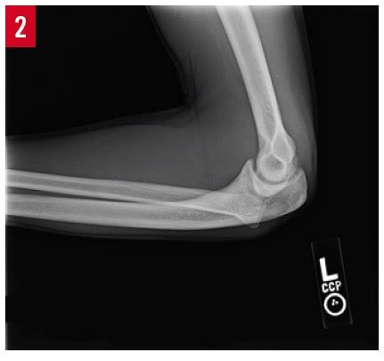 Congenital Posterior Dislocation of the Radial Head | Consultant360