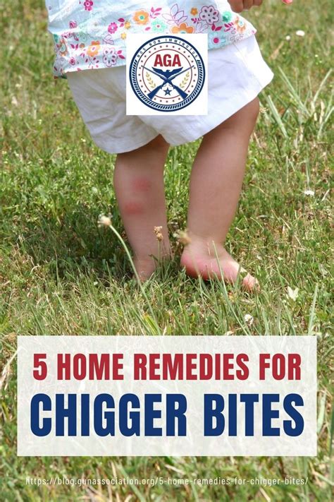 5 Home Remedies For Chigger Bites