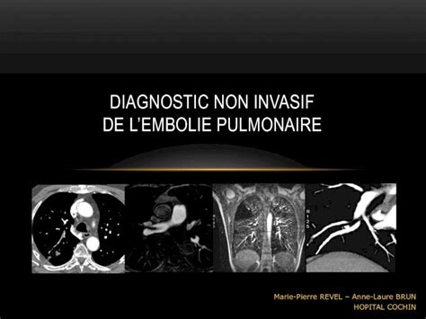 Pdf Diagnostic Non Invasif De Lembolie Pulmonairedes Pneumo Org Wp