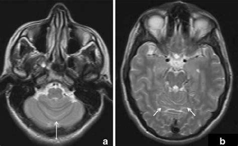 Magnetic Resonance Axial T2 Weighted Tr Te 4 500 110 A B Imaging