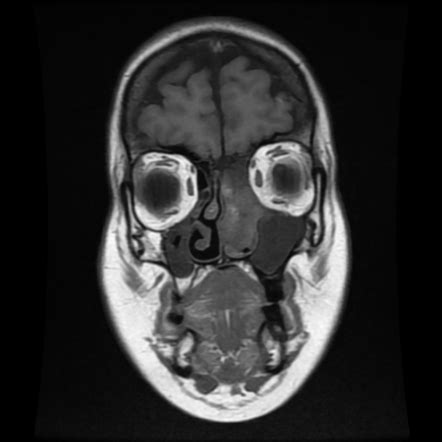 Sinonasal Adenocarcinoma Image Radiopaedia Org