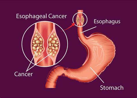 Dr Viraj Lavingia Expert In Esophageal Cancer Treatment And Care