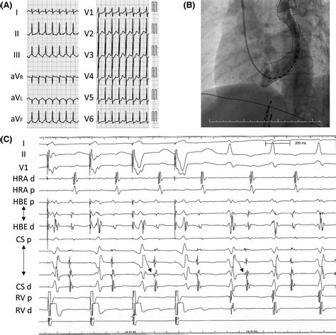 A Twelve‐lead Electrocardiogram During The Patients Tachycardia