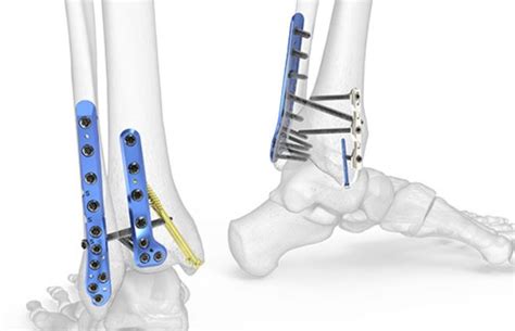 Lateral Malleolus Fracture – Orthopedic Implants Manufacturers India