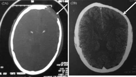 Ct Scan Showing The Lytic Skull Lesion And Its Resoluti Open I