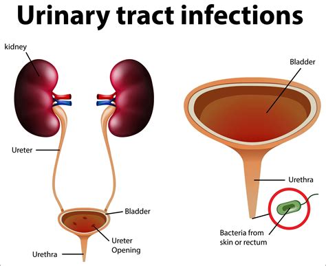 Urinary Tract Infection UTIs Symptoms Causes And Treatment