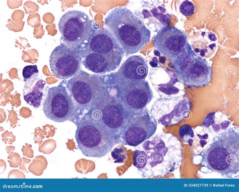 Mesothelial Cells in Pleural Fluid. Stock Image - Image of hyperplasia ...