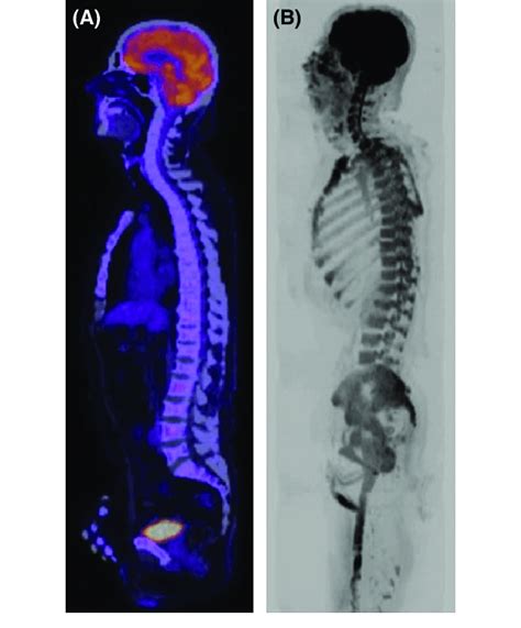 Diffusion Weighted Magnetic Resonance Imaging Dw Mri Shows Increased