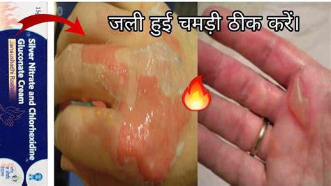 Silver Nitrate and Chlorhexidine Gluconate Cream जल हई चमड ठक