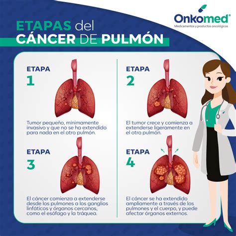 Etapas Del C Ncer De Pulm N Onkomed Farmacia