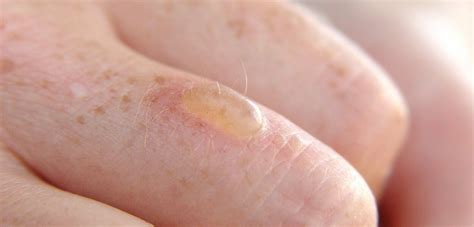 How Do You Treat A Burn Blister Alhydran Co Uk