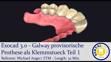 2021 Exocad 3 0 Tutorial Vorschau Galway Provisorische Prothese Als