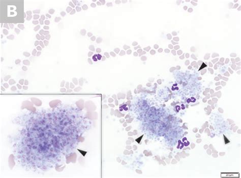 Blood Smear Platelet Evaluation & Interpretation | Clinician's Brief