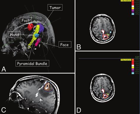 Three-dimensional rendering (A) of combined morphological MRI, DTI ...