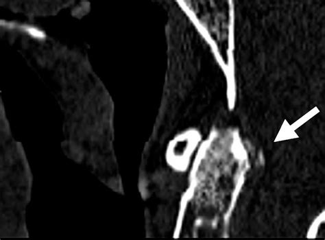 Calcificación Del Ligamento Transverso Del Atlas Síndrome De Crowned