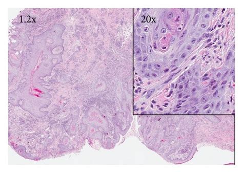 Hematoxylin Eosin Stain 1 2x And 20x Right Inset Of Scrotal Lesion