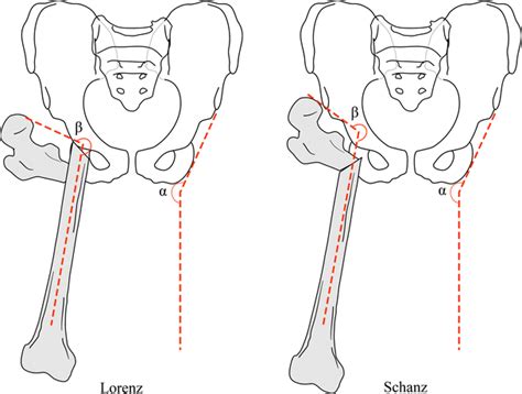 The Pelvic Support Osteotomy Indications And Preoperative Planning