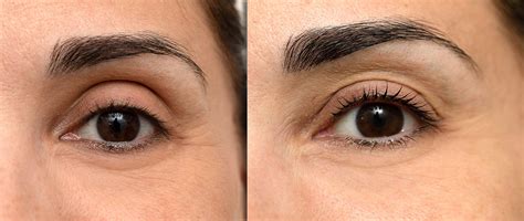 Blefaroplastia Superior Qué es y Cómo se realiza