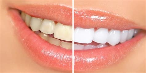 3 Easy And Cheap Tips To Keep Your Teeth White Naturally Ncyclopaedia