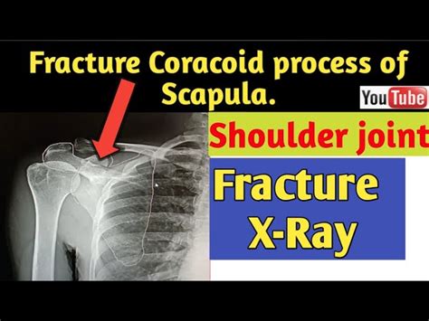 Coracoid Process Of Scapula