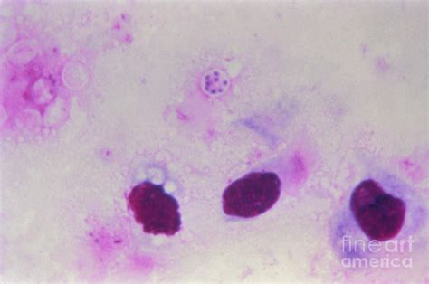 Pneumocystis Jirovecii Histology