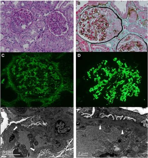 Diffuse Proliferative Glomerulonephritis Em