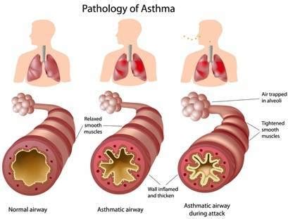 Asthma: Symptoms, Complications, and Treatment