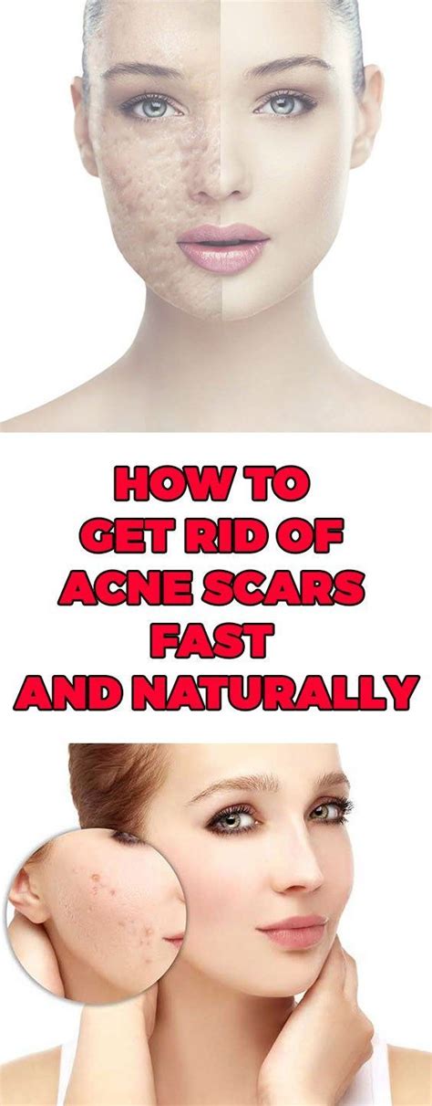 How To Heal Acne Fast And Naturally Food Blog