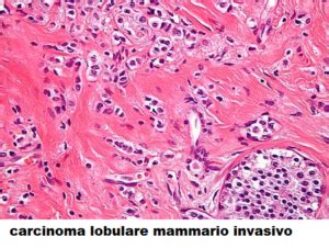 Carcinoma Mammario Lobulare Invasivo FertilityCenter