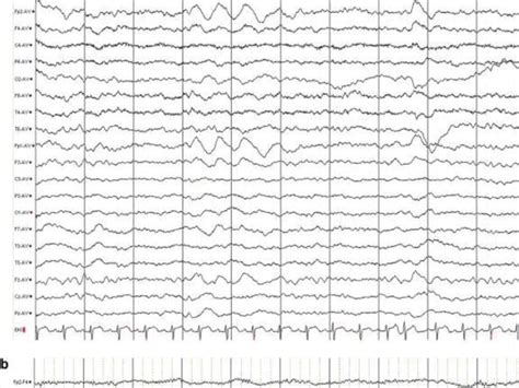 Periodic Eeg Patterns In The Intensive Care Unit Icu Definition