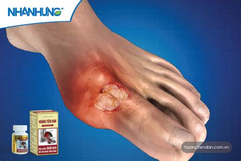 Dấu Hiệu Của Bệnh Gout Cách Nhận Biết Cấp độ Bệnh Gout Qua Từng Giai đoạn