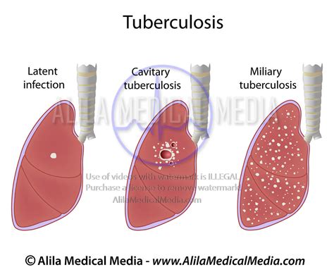 Alila Medical Media Tuberculosis Types Medical Illustration