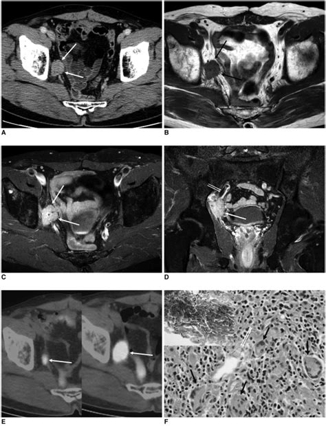 year  man  suture granuloma  contrast enhanced axial ct