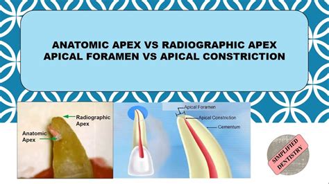 Anatomic Apex Vs Radiographic Apex Apical Foramen Vs Apical