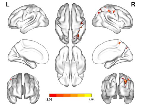 The Reho Value In The Right Posterior Central Gyrus The Right Superior