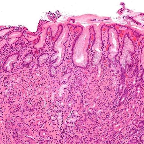 H E Stained Section Of An Inflamed Infected With H Pylori Gastric