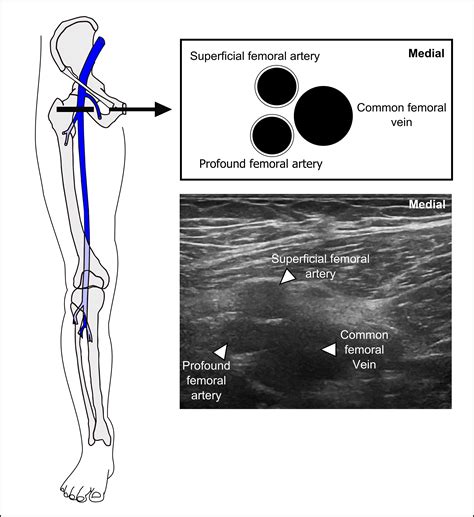 Deep Femoral Artery Ultrasound