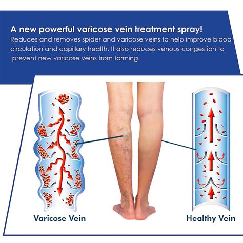 Varices Cr Me Veines Spider Varices Cr Me Veineuses Am Liore La