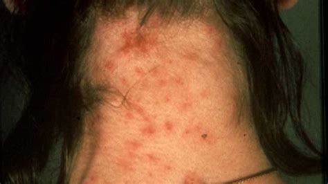 Lice Bites: How to Identify and Treat