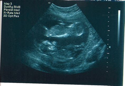 ronsasecu: 3d ultrasound pictures of twins