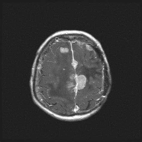 Meningioma CT - wikidoc