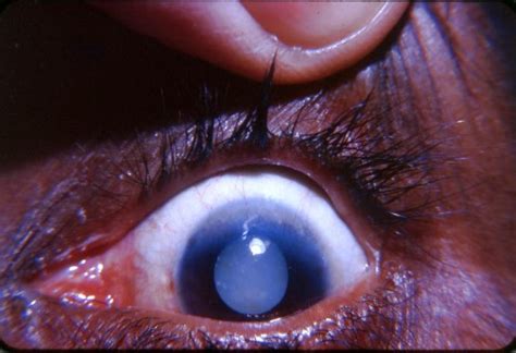 Pannus Superior Limbus With Morgagnian Cataract Online