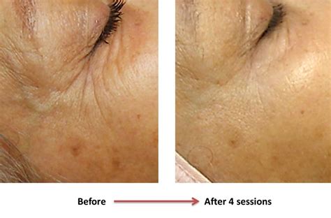 Laser Eye Wrinkle Reduction* – Canadian Optic & Laser Rejuvenation Center (COL Center)