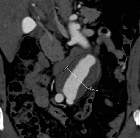 Abdominal Aortic Aneurysms Revisited MDCT With Multiplanar