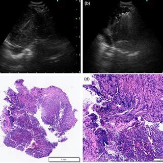 Endobronchial Ultrasound Ebus Images And Pathological Findings Of The