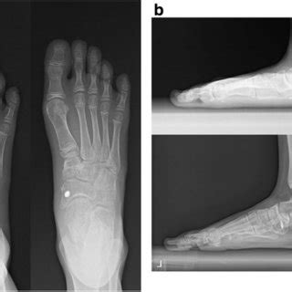 Comparative Preoperative And Year Postoperative Radiographs Of A