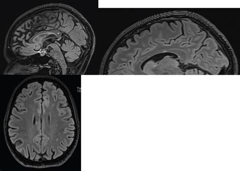 Susac Syndrome Collaboration Is Required For A Diagnosis