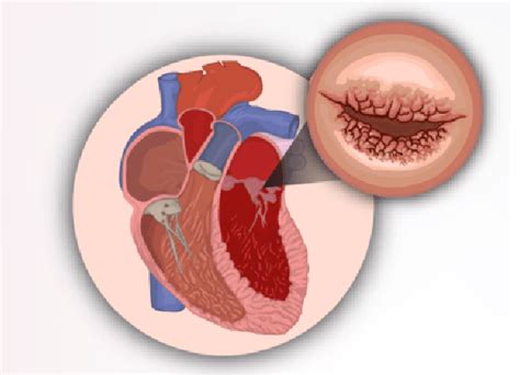 There Is A Link Between Rheumatic Heart Disease And Rheumatic Fever Samwumed